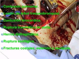 Contusión pulmonar.
Lesión de árbol traqueobronquial.
Contusión miocárdica.
Ruptura traumática de aorta.
Hernia diafragmática.
Ruptura esofágica.
Fracturas costales, esternón y escápula.
 