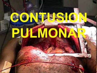 CONTUSION
PULMONAR
 