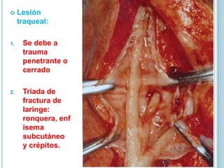  Lesión
traqueal:
1. Se debe a
trauma
penetrante o
cerrado
2. Triada de
fractura de
laringe:
ronquera, enf
isema
subcutáneo
y crépitos.
 
