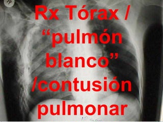 Rx Tórax /
“pulmón
blanco”
/contusión
pulmonar
 