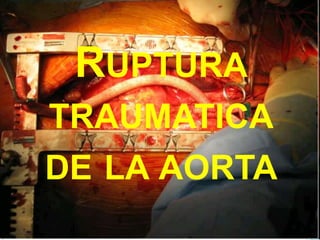 RUPTURA
TRAUMATICA
DE LA AORTA
 