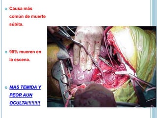  Causa más
común de muerte
súbita.
 90% mueren en
la escena.
 MAS TEMIDA Y
PEOR AUN
OCULTA!!!!!!!!!
 