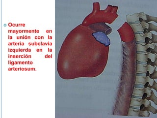  Ocurre
mayormente en
la unión con la
arteria subclavia
izquierda en la
inserción del
ligamento
arteriosum.
 