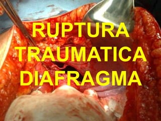 RUPTURA
TRAUMATICA
DIAFRAGMA
 
