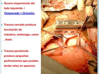  Ocurre mayormente del
lado izquierdo. /
Tamponade + Oclusión.
 Trauma cerrado produce
herniación de
intestino, estómago, colon
, bazo.
 Trauma penetrante
produce pequeñas
perforaciones que pueden
tardar años en aparecer.
 