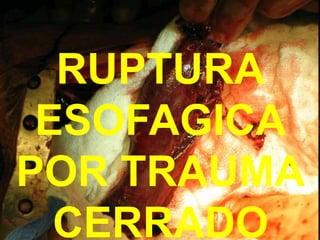 RUPTURA
ESOFAGICA
POR TRAUMA
CERRADO
 