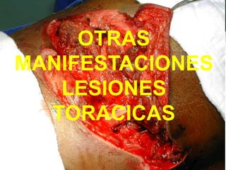 OTRAS
MANIFESTACIONES
LESIONES
TORACICAS
 