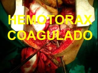 HEMOTORAX
COAGULADO
 