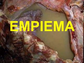 EMPIEMA
 