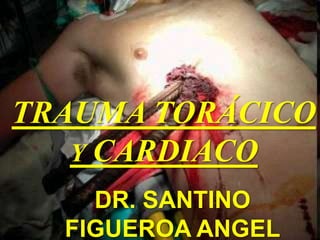 TRAUMA TORÁCICO
Y CARDIACO
DR. SANTINO
FIGUEROA ANGEL
 