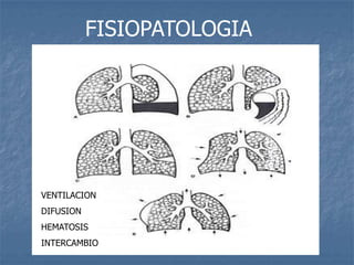 FISIOPATOLOGIA




VENTILACION
DIFUSION
HEMATOSIS
INTERCAMBIO
 