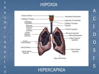 T
    HIPOXIA
R
A
                  A
U
                  C
M
A                 I
                  D
T
O                 O
R
Á
                  S
C
                  I
I
C                 S
O
    HIPERCAPNIA
 