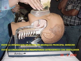 EVITE LA INTUBACION SELECTIVA DE BRONQUIO PRINCIPAL DERECHO

EVITE LA CREACION DE UN NEUMOTORAX IATROGENICO CON VENTILADOR
 