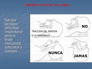 OBSTRUCCION DE VIA AÉREA




Estridor
laríngeo;
dificultad                                  NO
respiratoria      TRACCION DEL MENTON

severa;           O LA MANDIBULA
tiraje
intercostal,
subcostal y
cianosis.                     NUNCA
                                          JAMAS
 