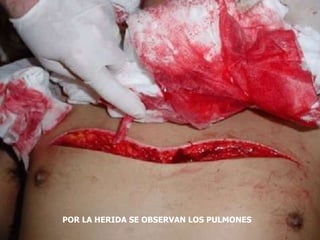 POR LA HERIDA SE OBSERVAN LOS PULMONES
 