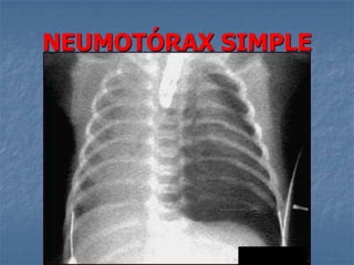 NEUMOTÓRAX SIMPLE
 