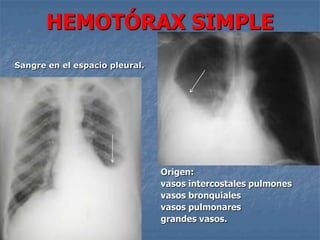 HEMOTÓRAX SIMPLE
Sangre en el espacio pleural.




                                Origen:
                                vasos intercostales pulmones
                                vasos bronquiales
                                vasos pulmonares
                                grandes vasos.
 