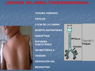 LESIONES DEL ARBOL TRAQUEOBRONQUIAL

            TRAUMA CERRADO

            FATALES

            2-3CM DE LA CARINA

            MUERTE INSTANTANEA

            HEMOPTISIS

            ENFISEMA
            SUBCUTÁNEO

            NEUMOTÓRAX A

            TENSIÓN

            DESVIACIÓN DEL

            MEDIASTINO
 