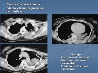    Cianosis de cara y cuello.
   Edema y hemorragia de las
    conjuntivas.




                                        Manejo
                                 Reconocer la entidad.
                                 Mantener vía aérea
                                 permeable.
                                 Cuidado de lesiones
                                 asociadas.
 