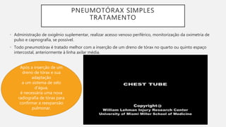 PNEUMOTÓRAX SIMPLES
TRATAMENTO
• Administração de oxigênio suplementar, realizar acesso venoso periférico, monitorização da oximetria de
pulso e capnografia, se possível.
• Todo pneumotórax é tratado melhor com a inserção de um dreno de tórax no quarto ou quinto espaço
intercostal, anteriormente à linha axilar média.
Após a inserção de um
dreno de tórax e sua
adaptação
a um sistema de selo
d'água,
é necessária uma nova
radiografia de tórax para
confirmar a reexpansão
pulmonar.
 