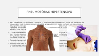 PNEUMOTÓRAX HIPERTENSIVO
• Pela semelhança dos sinais e sintomas, o pneumotórax hipertensivo pode, inicialmente, ser
confundido com tamponamento cardíaco. A diferenciação pode ser feita por timpanismo
notado à percussão, desvio da traqueia e ausência de murmúrio vesicular no hemitórax
afetado, que são os sinais de pneumotórax hipertensivo.
• O pneumotórax hipertensivo exige descompressão imediata e pode ser tratado inicialmente
pela rápida inserção de uma agulha de grosso calibre no segundo espaço intercostal, na linha
medioclavicular do hemitórax afetado.
• Quando bem sucedida, essa manobra converte a lesão em um pneumotórax simples.
• Mesmo com uma agulha de tamanho adequado, a manobra nem sempre será bem-sucedida.
O tratamento definitivo requer a inserção de um dreno torácico no quinto espaço intercostal
 
