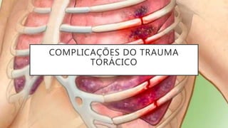 COMPLICAÇÕES DO TRAUMA
TORÁCICO
 