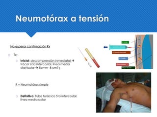 ҉ Tx:
҉ Inicial: descomprensión inmediata! 
trócar 2da intercostal, línea media
clavicular  5cmm- 8 cm?¿
҉ Definitivo: Tubo torácico 5ta intercostal,
línea media axilar
No esperar confirmación Rx
R = Neumotórax simple
Neumotórax a tensión
 
