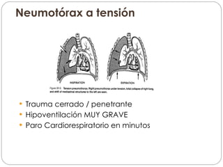 Neumotórax a tensión Trauma cerrado / penetrante Hipoventilación MUY GRAVE Paro Cardiorespiratorio en minutos 