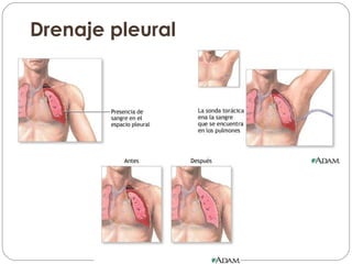 Drenaje pleural 