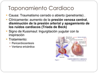 Taponamiento Cardiaco Causa: Traumatismo cerrado o abierto (penetrante) . Clínicamente: aumento de la  presión venosa central ,  disminución de la presión arterial y apagamiento de los ruidos cardiacos (Triada de Beck) Signo de Kussmaul: Ingurgitación yugular con la inspiración Tratamiento:  Pericardiocentesis Ventana ericárdica 