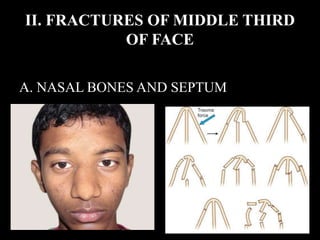 Trauma to the face | PPTX