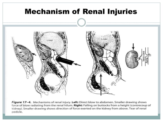Trauma to the genitourinary tract. | PPTX