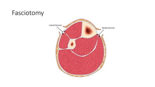 Fasciotomy
 