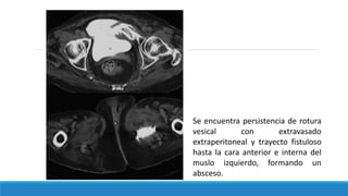 Se encuentra persistencia de rotura
vesical con extravasado
extraperitoneal y trayecto fistuloso
hasta la cara anterior e interna del
muslo izquierdo, formando un
absceso.
 