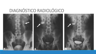 DIAGNÓSTICO RADIOLÓGICO
Las lesiones ureterales pueden causar signos radiológicos de obstrucción de las vías
urinarias superiores, el elemento imprescindible de lesión ureteral es la extravasación del
medio de contraste radiológico.
pielografia intravenosa (PIV)(2 mg de contraste/kg peso) por kilogramo de peso corporal)
uso creciente de la TC en los pacientes politraumatizados, el diagnostico se hace cada vez
mas con esta modalidad.
 