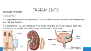 TRATAMIENTOLESIONES PARCIALES
GRADO I A II
la implantación de una endoprotesis ureteral o la colocación de un tubo de nefrostomía
para desviar la orina.
la presencia de una endoprotesis en la lesión permitirá un drenaje seguro del riñón,
además de proporcionar canalización y estabilización de la lesión
 