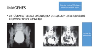 IMAGENES
• CISTOGRAFIA TECNICA DIAGNOSTICA DE ELECCION , mas exacto para
determinar rotura y gravedad.
Distesion optima 350ml para
evidenciar posible lesion
Escape de
crontraste
 