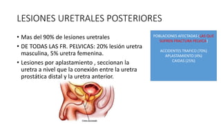 LESIONES URETRALES POSTERIORES
• Mas del 90% de lesiones uretrales
• DE TODAS LAS FR. PELVICAS: 20% lesión uretra
masculina, 5% uretra femenina.
• Lesiones por aplastamiento , seccionan la
uretra a nivel que la conexión entre la uretra
prostática distal y la uretra anterior.
POBLACIONES AFECTADAS (LAS QUE
SUFREN FRACTURA PELVICA)
ACCIDENTES TRAFICO (70%)
APLASTAMIENTO (4%)
CAIDAS (25%)
 