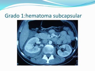 Grado 1:contusión renal