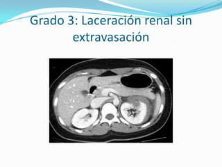 Grado 2: Hematoma subcapsular y perirrenal