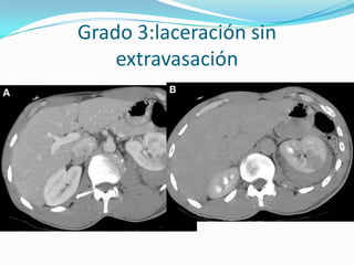 Grado 3: Laceración renal sin extravasación