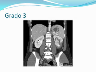 Grado 3:laceración sin extravasación