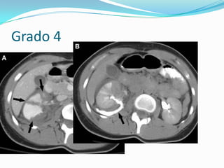 Grado 4:laceracion vía y extravasación 