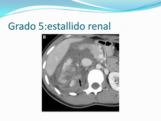 Grado 5: Lesión arteria renal