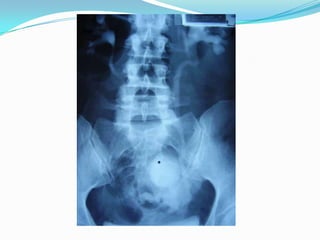 TRAUMA URETERALPENSAR EN TRAUMA URETERAL SI:DOLOR LUMBARFIEBREILEOPERDIDA DE ORINA POR DRENAJE