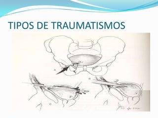 Traumatismo de vejiga Clasificación:CERRADO: 65-85%PENETRANTE: 15-35%Intraperitoneal: vejiga llena(15 a 45 %)Extraperitoneal: vejiga vacía (50 a 85 %)Ambas (1 a 2%)El 85% de los traumatizados vesicales,tienen rotura uretral posterior