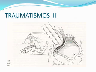 TIPOS DE TRAUMATISMOS