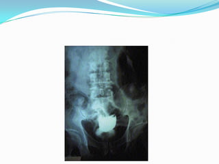 distensión abdominal.ROTURA INTRAPERITONEALES UN TRAUMA A VEJIGA LLENAPERFORACION Y ROTURA EN CÚPULANO SINDROME DISOCIADOimposibilidad de micción SIN globo vesicalPERITONITIS QUIMICA