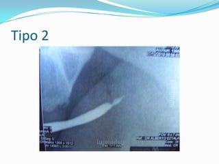 TRATAMIENTOLesión extraperitoneal, conservador cateterizar vejiga con sonda Foley, 10 a 14 días con antibióticos. Lesión intraperitoneales, realizar laparotomía exploradora para descartar lesiones y drenar uroperitoneoLesión penetrante, será tratada quirúrgicamente de inmediato, constatar eyaculación de ureteres y si hay lesión catéter doble J 