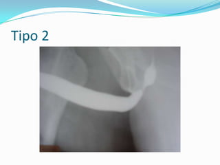 TRAUMA URETRALLESIÓN URETRA POSTERIORSOSPECHARLO si fracturas pélvicas, en la mayor parte de los casos como resultado de accidentes con vehículos motorizados. La uretra posterior masculina se ve afectada en un 4-19% de las fracturas pélvicas El mayor riesgo de lesión uretral aparece cuando se combina una fractura de las cuatro ramas pubianas con la diástasis de la articulación sacroilíaca. Las lesiones pueden ir desde una lesión por elongación hasta la ruptura parcial o la ruptura completa.